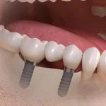 Dental implant