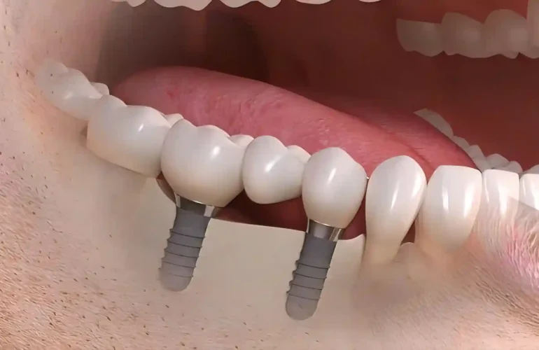 Dental implant