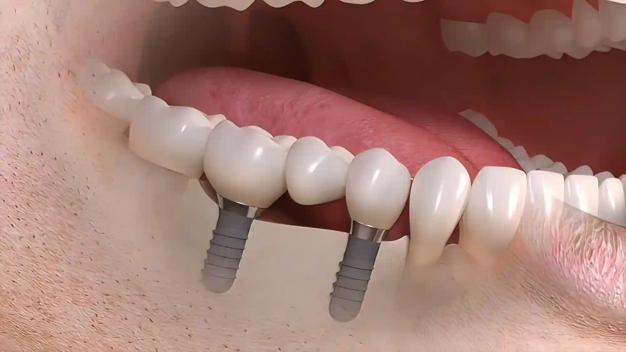 Dental implant