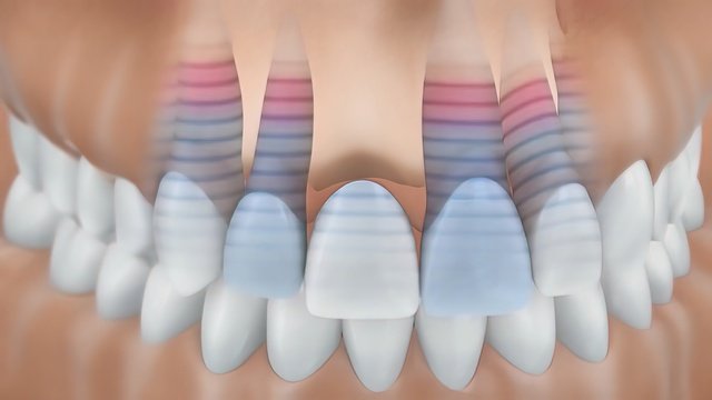 How Receding Gums Can Be Fixed With Cosmetic Dentistry?